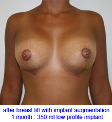 plastic-surgery-breast-lift-augmentation